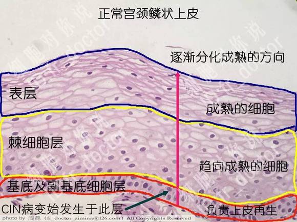 关于cin的论述以下哪项是不正确的: a.属于宫颈癌的癌前病变b.