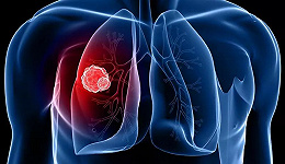 向治愈肺癌迈出重要一步，NEJM重磅发表新成果