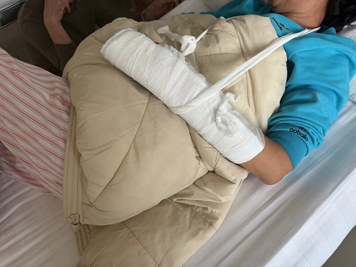 李秀娟左手小拇指骨折，在医院简单包扎后等待手术。摄影：记者吕雅萱
